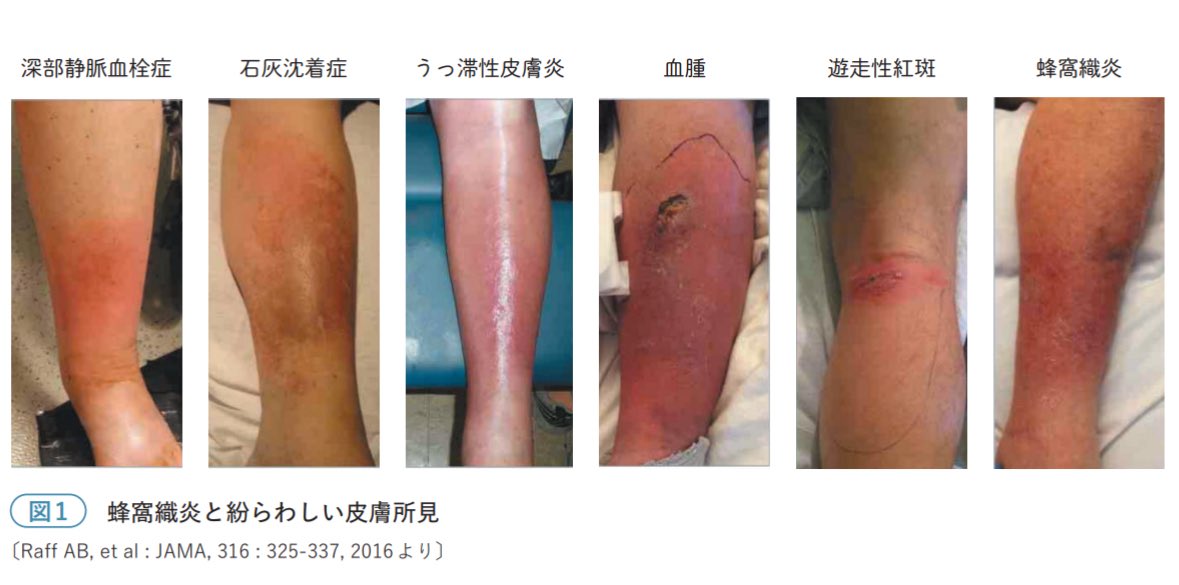yukina_minhos's tweet photo. 蜂窩織炎の鑑別はむっちゃむずいと思います

見た目だけじゃなく
熱さ
痛み
部位の左右非対称性
経過

などなど
かなり複数要素から鑑別するようにしてます

このスコアも点数を気にするというより
✅点数がつく項目が何なのか？を理解

して注意深く患者さんをみれるといい気がします🌟

⬇️以前バズった蜂窩織炎はどれ？の投稿です。
https://t.co/ueyOqlrgZd