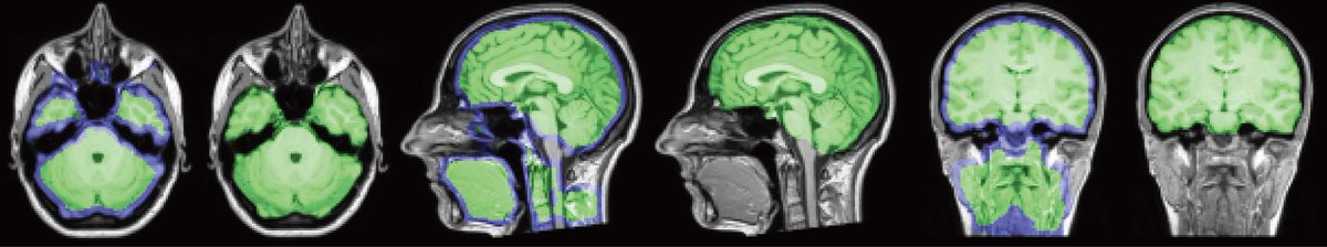 PUMBA: A skull-stripping model trained using purely synthetic data, no real brains or labels required. It generalizes across species, modalities, and pathologies out-of-the-box without additional fine-tuning.

Preprint by Jong Sung Park <a href="/get_user_data/">Jong Sung Park</a>: arxiv.org/abs/2505.07159