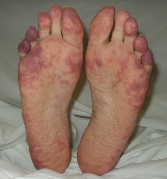 docakx's tweet image. A patient who was initiated on Warfarin develops this.

What happened❓️

Image from clotconnect.org

#DrAkhilX