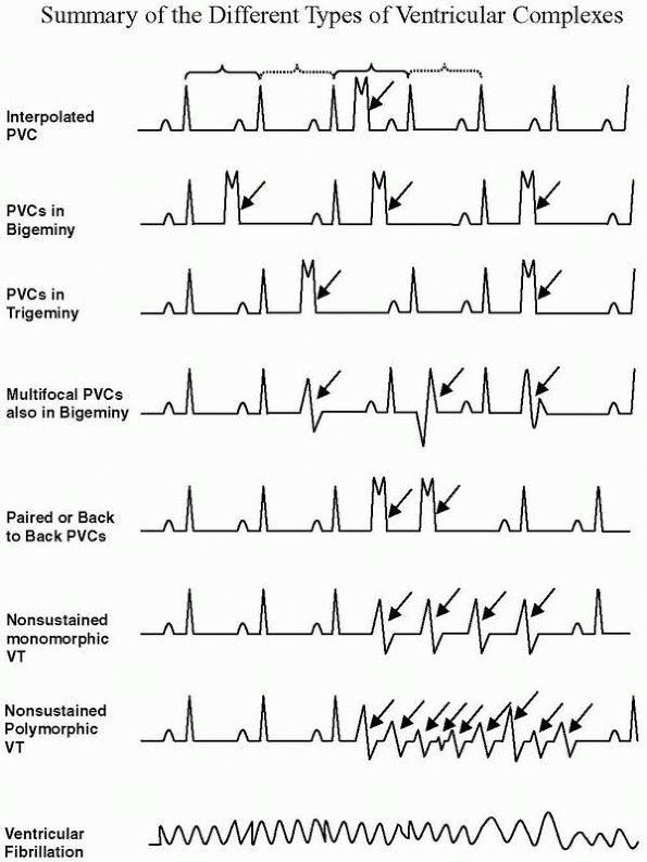 TrackYourHeart's tweet photo. Summary of the different types of ventricular complexes.

1️⃣ Interpolated PVCs
✅ A PVC occurs between two normal beats without disrupting the sinus rhythm.
✅ No compensatory pause.
✅ Often seen in bradycardic patients.

2️⃣ PVCs in Bigeminy
✅ Every normal beat (sinus beat) is followed by a PVC → Regular pattern.
✅ The PVC is premature and typically has a wide QRS complex.

3️⃣ PVCs in Trigeminy
✅ Two normal beats followed by a PVC, repeating in a cycle.
✅ A predictable ventricular ectopy pattern.

4️⃣ Multifocal PVCs 
✅ PVCs originate from multiple foci, showing different QRS morphologies.
✅ Indicates more ventricular instability than unifocal PVCs.

5️⃣ Paired or Back-to-Back PVCs
✅ Two consecutive PVCs occurring without an intervening sinus beat.

6️⃣ Nonsustained Monomorphic Ventricular Tachycardia (NSVT)
✅ Three or more consecutive PVCs at a rate >100 bpm, but lasting <30 sec.
✅ Monomorphic: All QRS complexes have the same shape (single ectopic focus).

7️⃣ Nonsustained Polymorphic Ventricular Tachycardia (NSVT)
✅ Three or more PVCs lasting <30 sec, but QRS morphology varies (multiple ectopic foci).
✅ Often associated with long QT syndrome, ischemia, or electrolyte abnormalities.

8️⃣ Ventricular Fibrillation (VF) – A Medical Emergency!
✅ Chaotic, disorganized electrical activity with no identifiable QRS complexes.
✅ The heart is quivering instead of pumping, leading to no cardiac output.
#Cardiology #ECG  #MedX