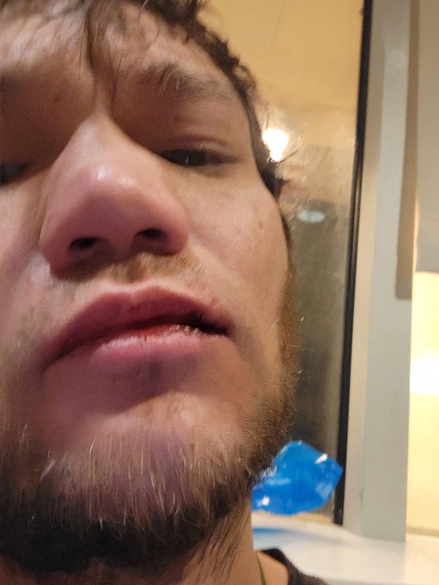 TaryxShadow's tweet image. Hello everybody. 

Tonight I was the one asaaulted by a man at the Portland ICE facility with a rock. 

He snuck up behind us and then hit me nearly unconscious, and took off down the street shortly after a group walked by us and smacked out phones out of our hands. 

I decided…