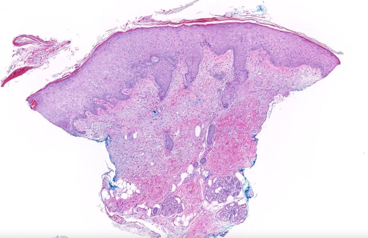 JMGardnerMD's tweet image. 65 yo woman with petechial eruption. Can you guess the patient's medical history?
Digital slide: kikoxp.com/posts/8026
Answer ✅ youtu.be/kaBrMU5OsFg?si…
#pathology #pathologists #pathTwitter #dermpath #dermatology #dermatologia #dermtwitter