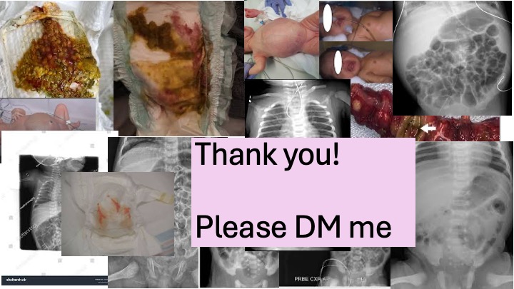 NeoResearch_Net's tweet photo. #Neonatal #GI #Nutrition
High-quality AXR & photo need for eLearning
Non-profit, non-commerce
Bile #blood stool, vomit, aspirate
Hirschsprung #NEC #volvulus
Double-bubble
ANYTHING!
#Free #consent #anonymised
Graphic?
Pls RT
Full credit
No $$ but you help improve 🌍outcomes https://t.co/hPdgSFC0gQ