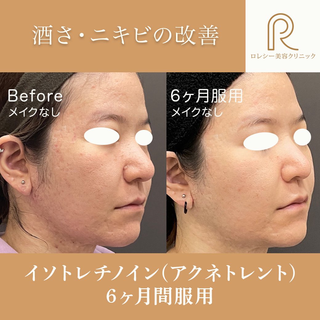 rolecy0605's tweet photo. 【Before → After】6ヶ月で変わる、肌質のリセット。
⠀ ニキビが繰り返す、治ってもまた出る… そんな「根本的に治したい」方に行うのが イソトレチノイン（アクネトレント）内服療法です。

https://t.co/fhu7t5a1ys https://t.co/7PJ8CtqOsz