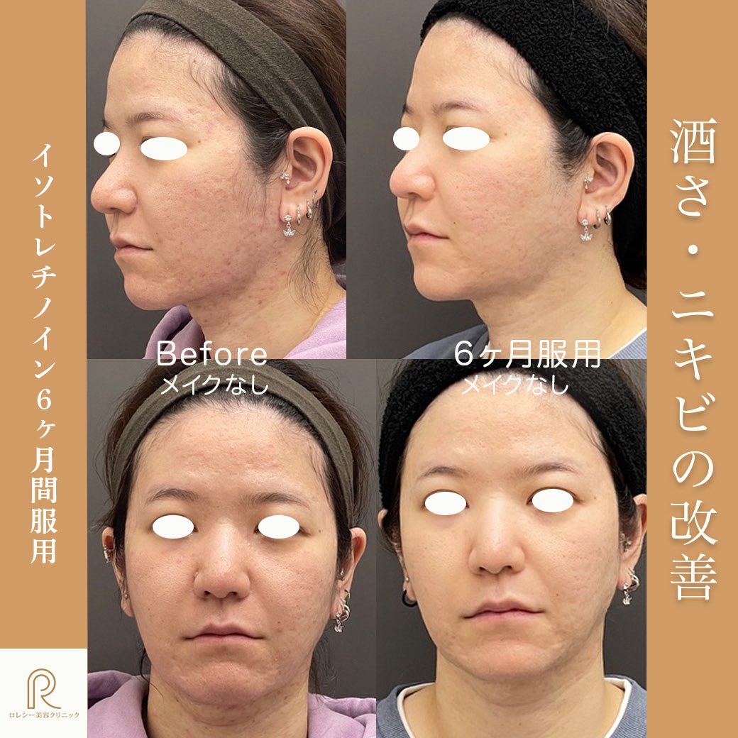 rolecy0605's tweet photo. 【Before → After】6ヶ月で変わる、肌質のリセット。
⠀ ニキビが繰り返す、治ってもまた出る… そんな「根本的に治したい」方に行うのが イソトレチノイン（アクネトレント）内服療法です。

https://t.co/fhu7t5a1ys https://t.co/7PJ8CtqOsz