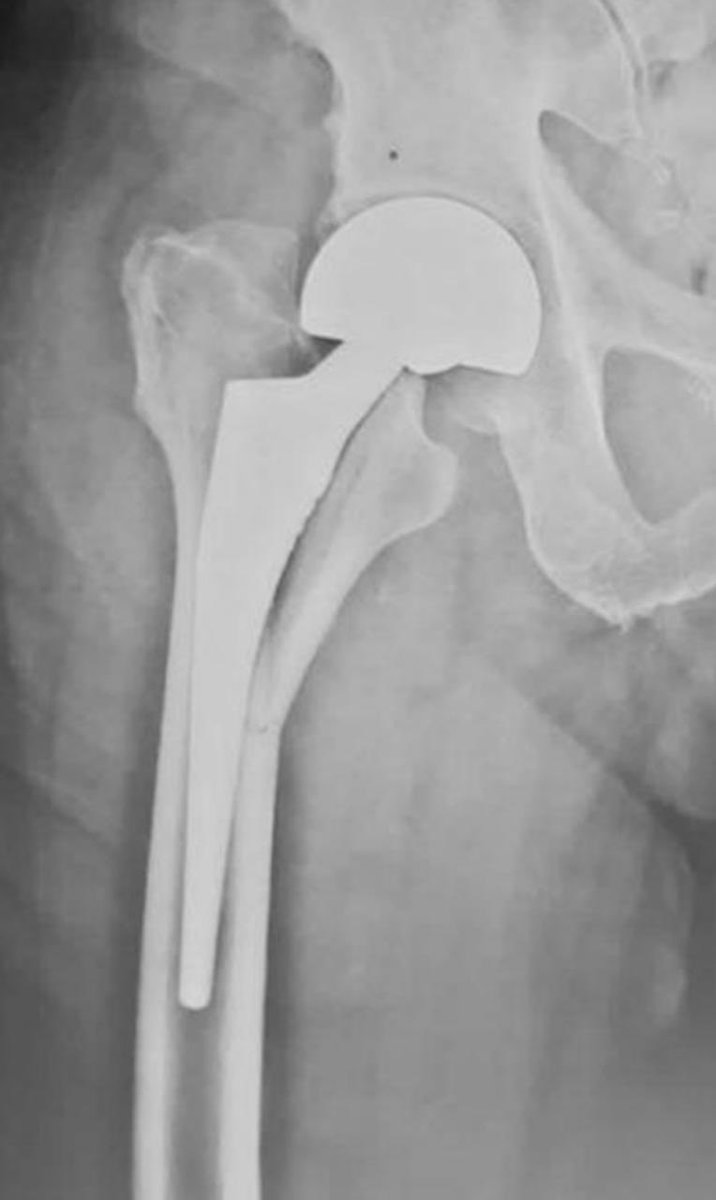 Bipin Theruvil FRCS (T&O),FRCS (Ed&Glasg),MS AIIMS tweet media