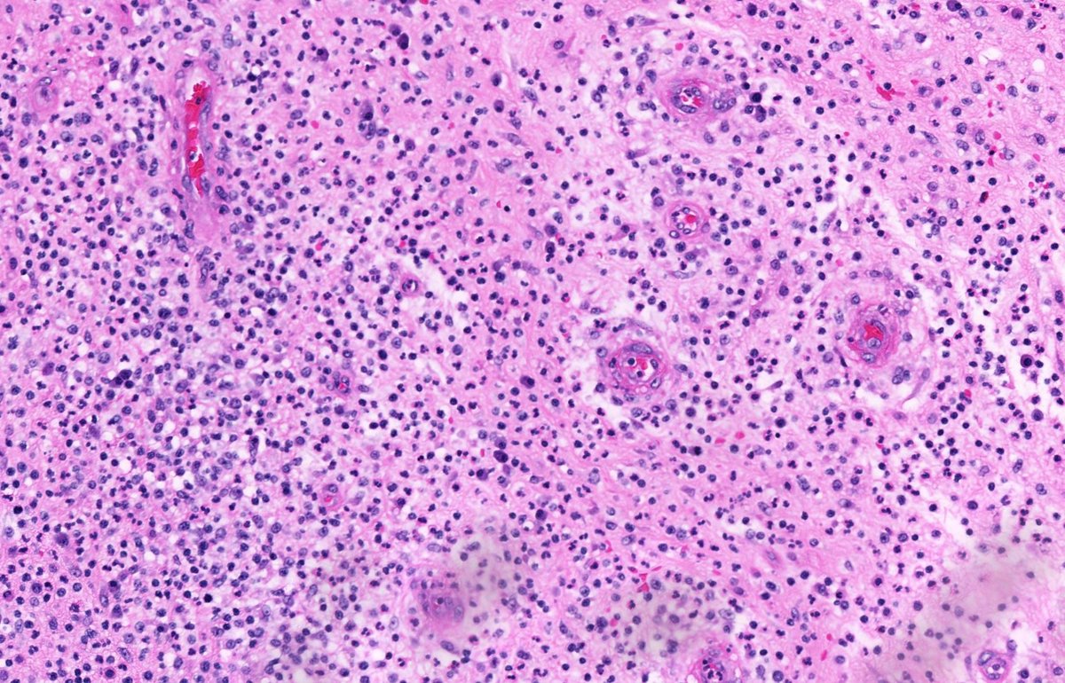 JMGardnerMD's tweet image. 20 yo F. Bilateral groin excisions. Diagnosis?
Digital slides: kikoxp.com/posts/8027
Answer ✅ youtu.be/Zy07nO1VuiY?si…
#pathology #pathologists #pathTwitter #dermpath #dermatology #dermatologia #dermtwitter