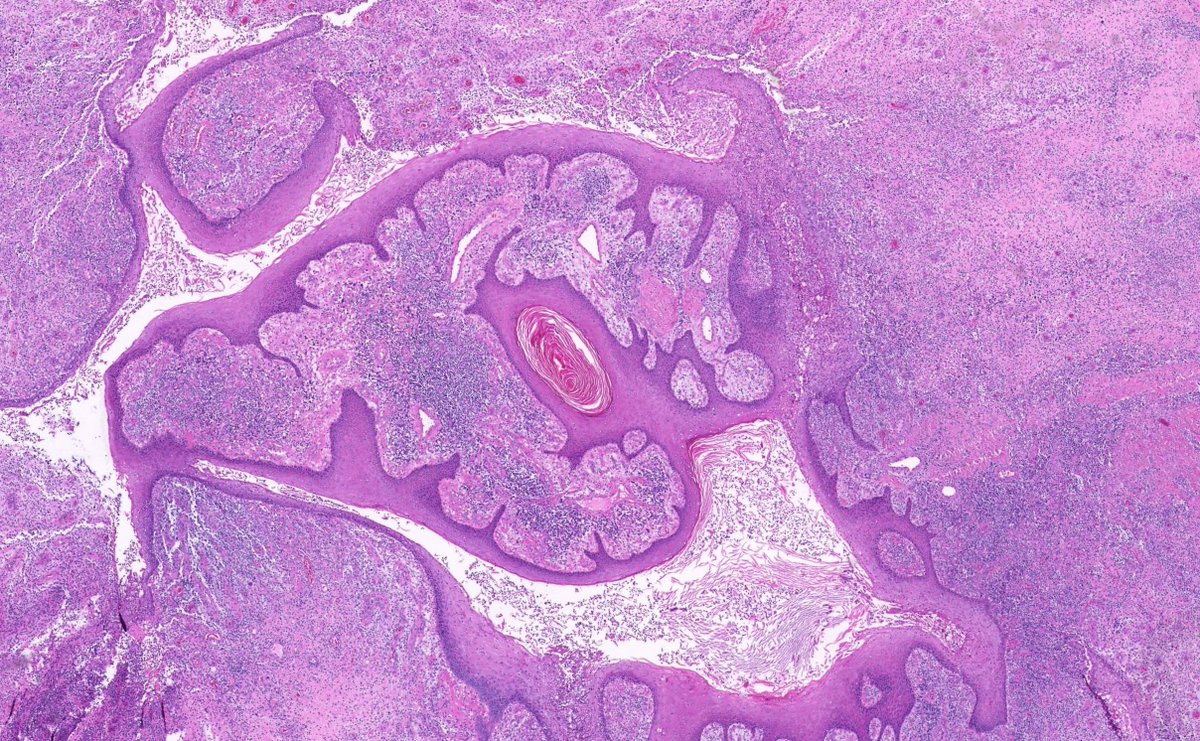 JMGardnerMD's tweet image. 20 yo F. Bilateral groin excisions. Diagnosis?
Digital slides: kikoxp.com/posts/8027
Answer ✅ youtu.be/Zy07nO1VuiY?si…
#pathology #pathologists #pathTwitter #dermpath #dermatology #dermatologia #dermtwitter