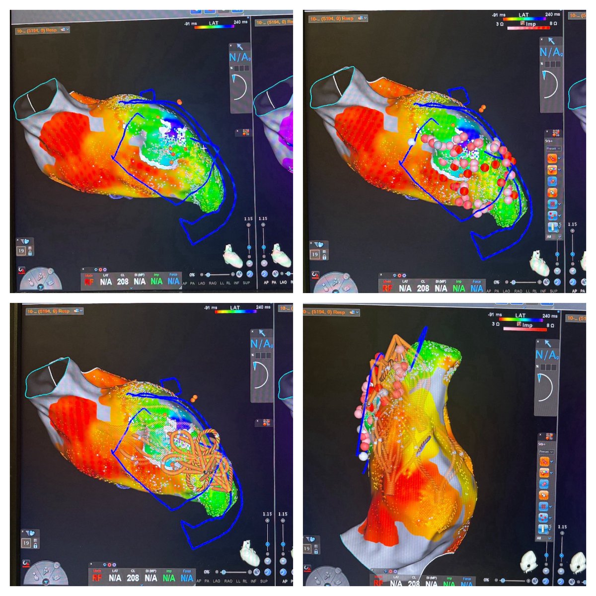 MohamedRShokr's tweet image. Combined RF/PFA for ischemic VT ( Anterior/anteroseptal scar/ apical aneurysm) @NorthernLightH 

The “ new” paradigm for ischemic VT ablation :

- Ablate early
- Minimize/avoid  VT induction 
- Identify lines of block ( WADL/ILAM/Peak frequency..etc )
- Combined RF/PFA 
- Same…