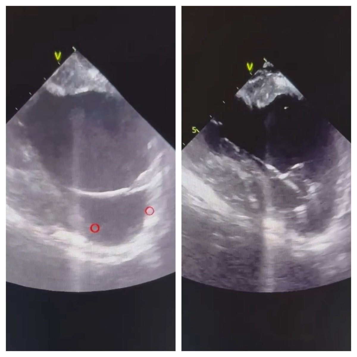 MohamedRShokr's tweet image. Combined RF/PFA for ischemic VT ( Anterior/anteroseptal scar/ apical aneurysm) @NorthernLightH 

The “ new” paradigm for ischemic VT ablation :

- Ablate early
- Minimize/avoid  VT induction 
- Identify lines of block ( WADL/ILAM/Peak frequency..etc )
- Combined RF/PFA 
- Same…