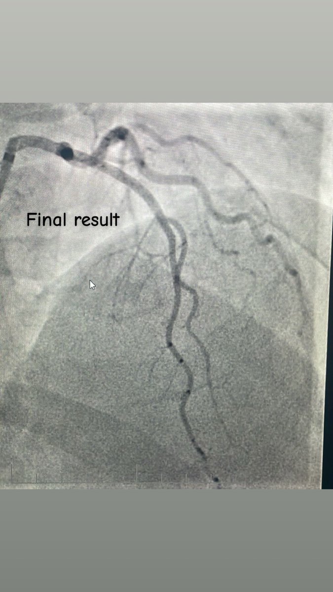 alasmary31's tweet image. CTO LAD
🔹Dual injection
🔹RCA with wire protection
🔹LAD with microcatheter
🔹Trapping technique to secure the wire
🛑 Always secure the donor first
📍 Microcatheter = Stability + Roadmap
⚠️ Don’t rush the setup, good prep = smoother case
😁 Happier than the patient.
#CTO…