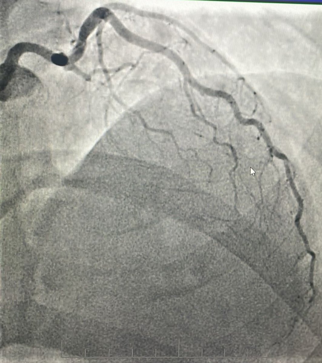 alasmary31's tweet image. CTO LAD
🔹Dual injection
🔹RCA with wire protection
🔹LAD with microcatheter
🔹Trapping technique to secure the wire
🛑 Always secure the donor first
📍 Microcatheter = Stability + Roadmap
⚠️ Don’t rush the setup, good prep = smoother case
😁 Happier than the patient.
#CTO…
