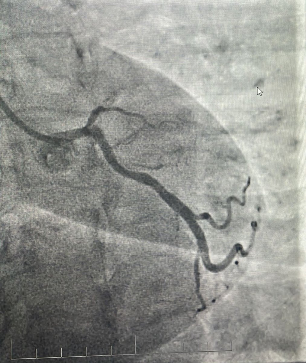 alasmary31's tweet image. CTO LAD
🔹Dual injection
🔹RCA with wire protection
🔹LAD with microcatheter
🔹Trapping technique to secure the wire
🛑 Always secure the donor first
📍 Microcatheter = Stability + Roadmap
⚠️ Don’t rush the setup, good prep = smoother case
😁 Happier than the patient.
#CTO…