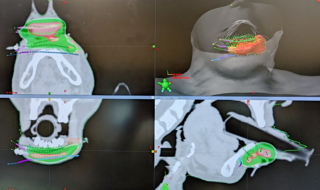 Dinesh Makuny (@dineshmakuny) on Twitter photo An invincible combo in lip brachytherapy is the combination of interstitial catheters with a surface mould . Acts truly an icing on a cake to keep hotspots within .The Patterson Parker rules still rule the Brachy kingdom.
#brachytherapy
#radtwitter An invincible combo in lip brachytherapy is the combination of interstitial catheters with a surface mould . Acts truly an icing on a cake to keep hotspots within .The Patterson Parker rules still rule the Brachy kingdom.
#brachytherapy
#radtwitter