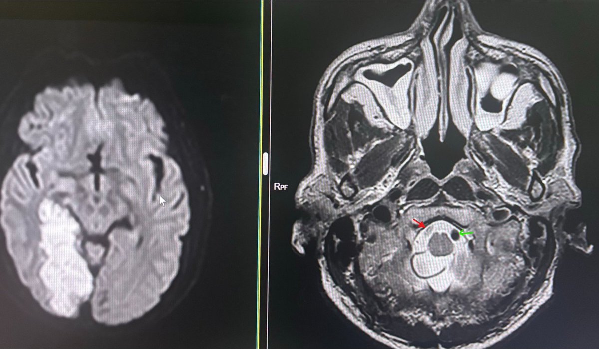 whitfieldlewis6's tweet photo. Yes, the MRI demonstrates an obvious right PCA distribution infarction.

In keeping with hypoperfusion along the right posterior circulation, there is a loss of flow void in the intracranial segment of the right vertebral artery (V4, denoted by the red arrow).

Note the normal flow void appearance (black signal) of the left vertebral artery, denoted by the green arrow.