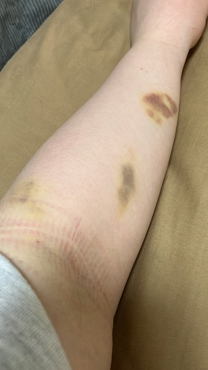 chiii1123589's tweet photo. 胃腸炎の時に点滴で失敗された跡たちやっと消えそうな感じになってきた😂点滴ほぼ毎回失敗されちゃうから毎回こわい、、、血管見えやすい人羨ましい、、、 https://t.co/DCLvKGlupl