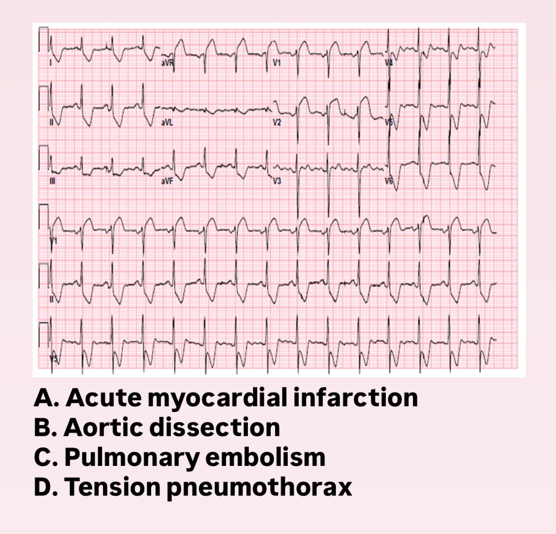 A 58-year-old man with a history of hypertension presents with sudden-onset severe chest pain radiating to the back. His blood pressure is 180/100 mmHg in the right arm and 130/80 mmHg in the left arm.

What’s the diagnosis? 🎯
