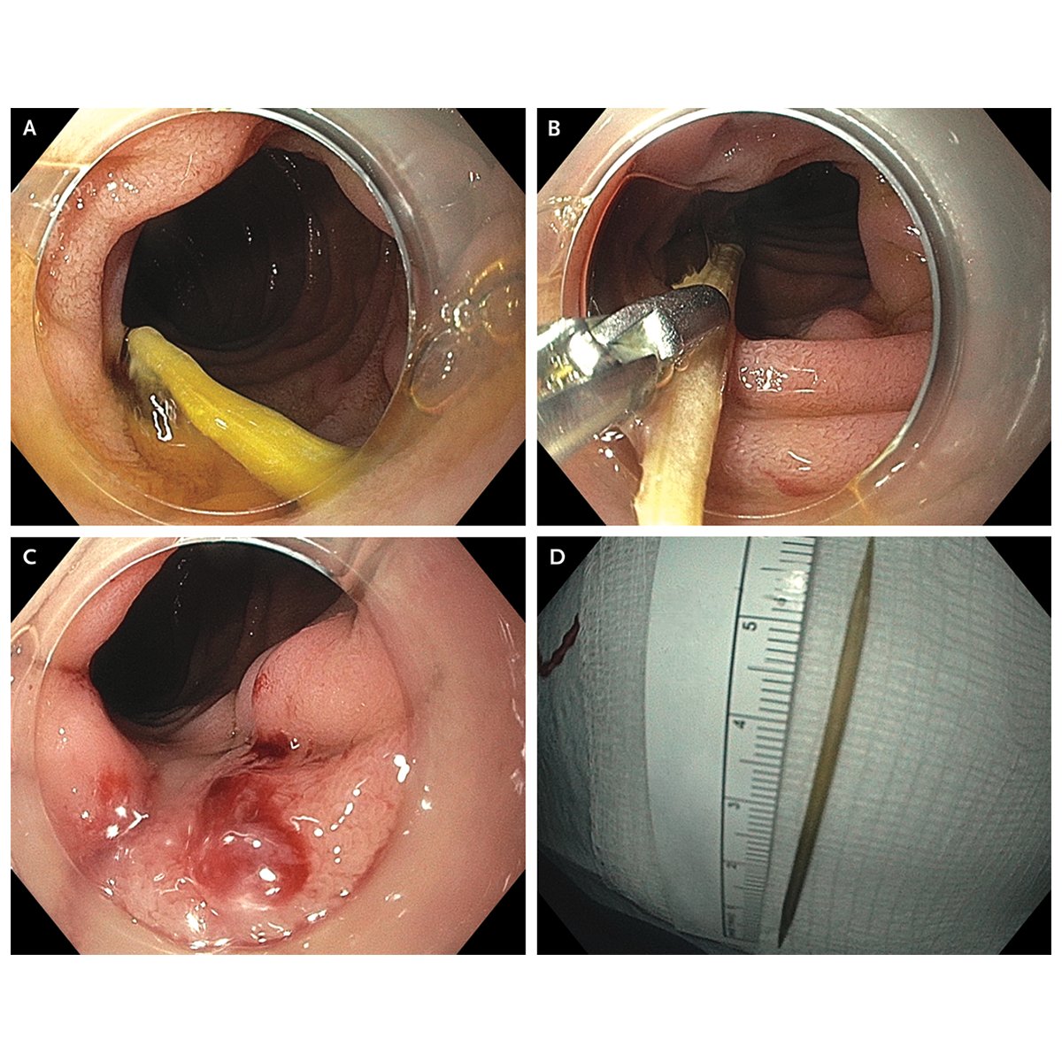 NEJM (@nejm) on Twitter photo Case Record of the Massachusetts General Hospital (<a href="/MassGeneralNews/">MassGeneral News</a>): A 36-year-old man was admitted because of fever, hypoxemia, and bacteremia. Imaging revealed pulmonary opacities, thickening of the duodenal wall, and a thrombus in the right renal vein.
The gastroenterology Case Record of the Massachusetts General Hospital (<a href="/MassGeneralNews/">MassGeneral News</a>): A 36-year-old man was admitted because of fever, hypoxemia, and bacteremia. Imaging revealed pulmonary opacities, thickening of the duodenal wall, and a thrombus in the right renal vein.
The gastroenterology