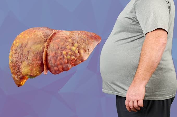 mindmusclepro's tweet image. Only Alcohol can cause Fatty liver regardless of Calorie excess, deficit or maintenance.

Saturated Fat &amp;amp; Fructose can cause Fatty liver to a small extent when consumed in excess on a Maintenance calorie diet also.

Refined Carbs &amp;amp; added Fats can cause severe Fatty liver when…