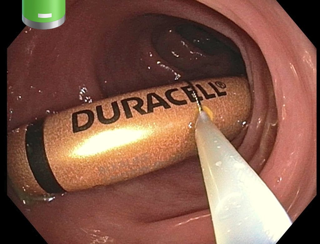 doc_zubin's tweet image. Not something you want your colon powered with.....@drkeithsiau @DrNeha90356702 @theliverdr @DrDeepakKrishn1 @gastro3570 @aditya_gan3500 @AmCollegeGastro @TheLancet @Duracell @DuraEnergy