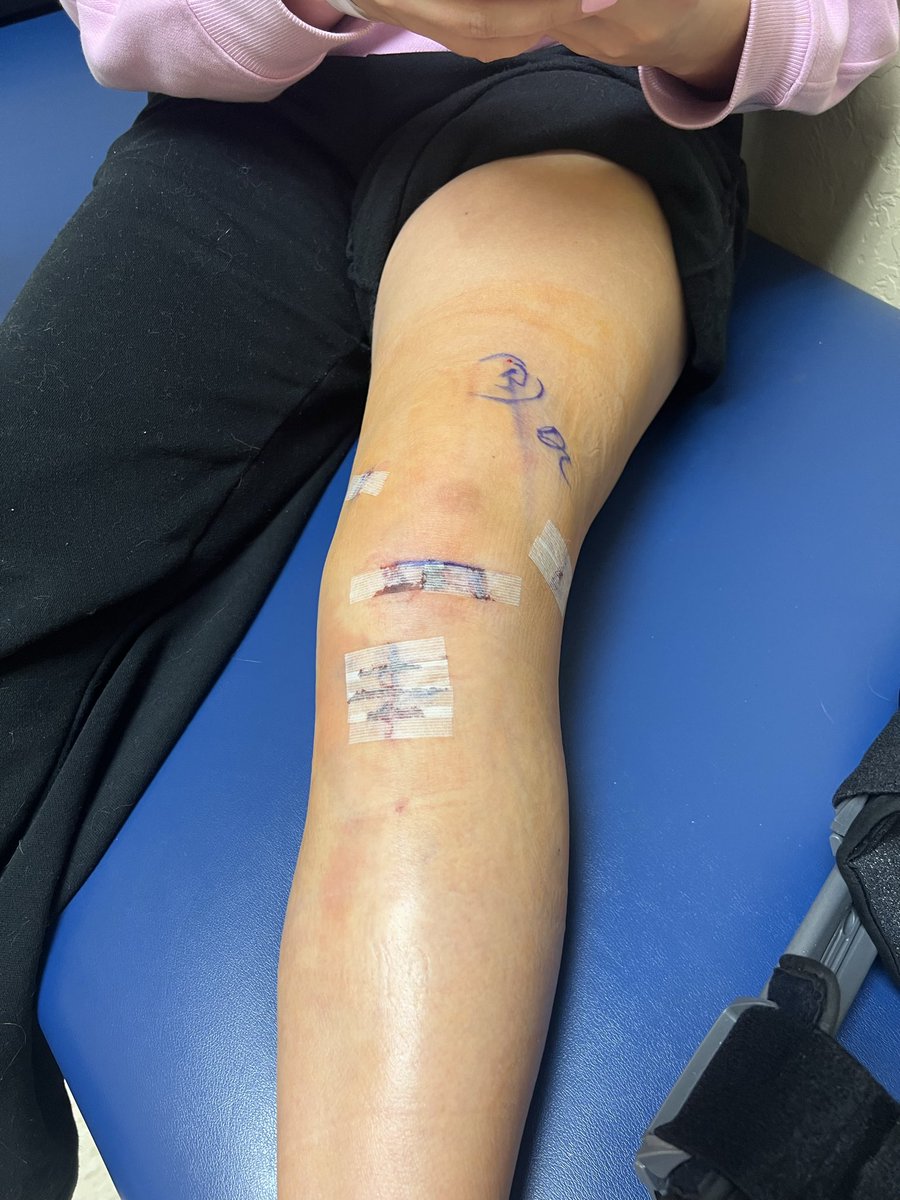 SophiaHolcomb28's tweet image. It’s been a long 10 month recovery from my ACL/Meniscus tear but I am finally fully released and ready to start the fall travel ball season! 🍂🥎 So grateful to my coaches, trainers and PTs who worked so hard to get me back on the field! 🙏🏼 Prayers would be appreciated as I…