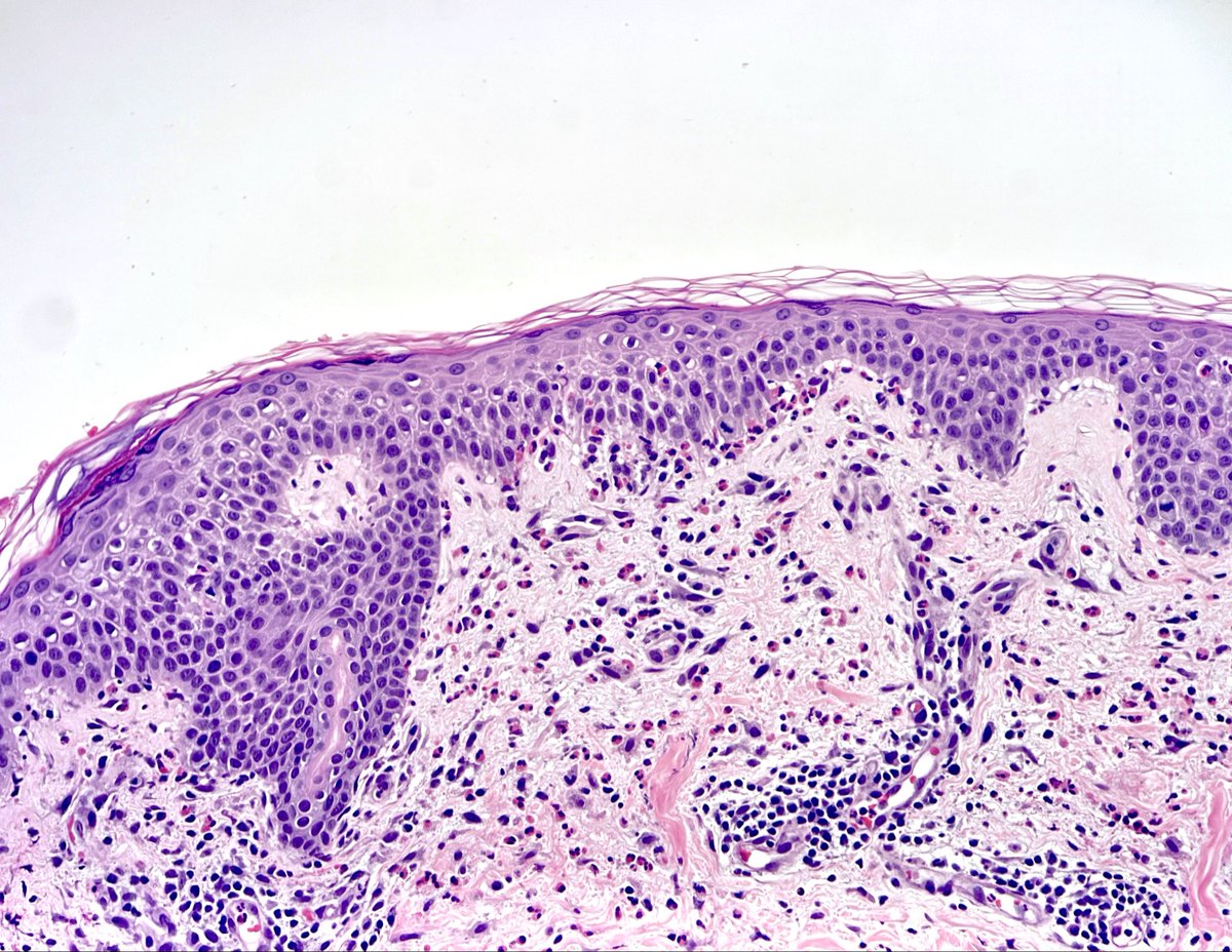 A clue to pre-bullous pemphigoid. 👀 how the eosinophils are lining up along the basement membrane and the space which is beginning to form beneath the epidermis.
#pathology
#dermatology
#dermpath 
💜