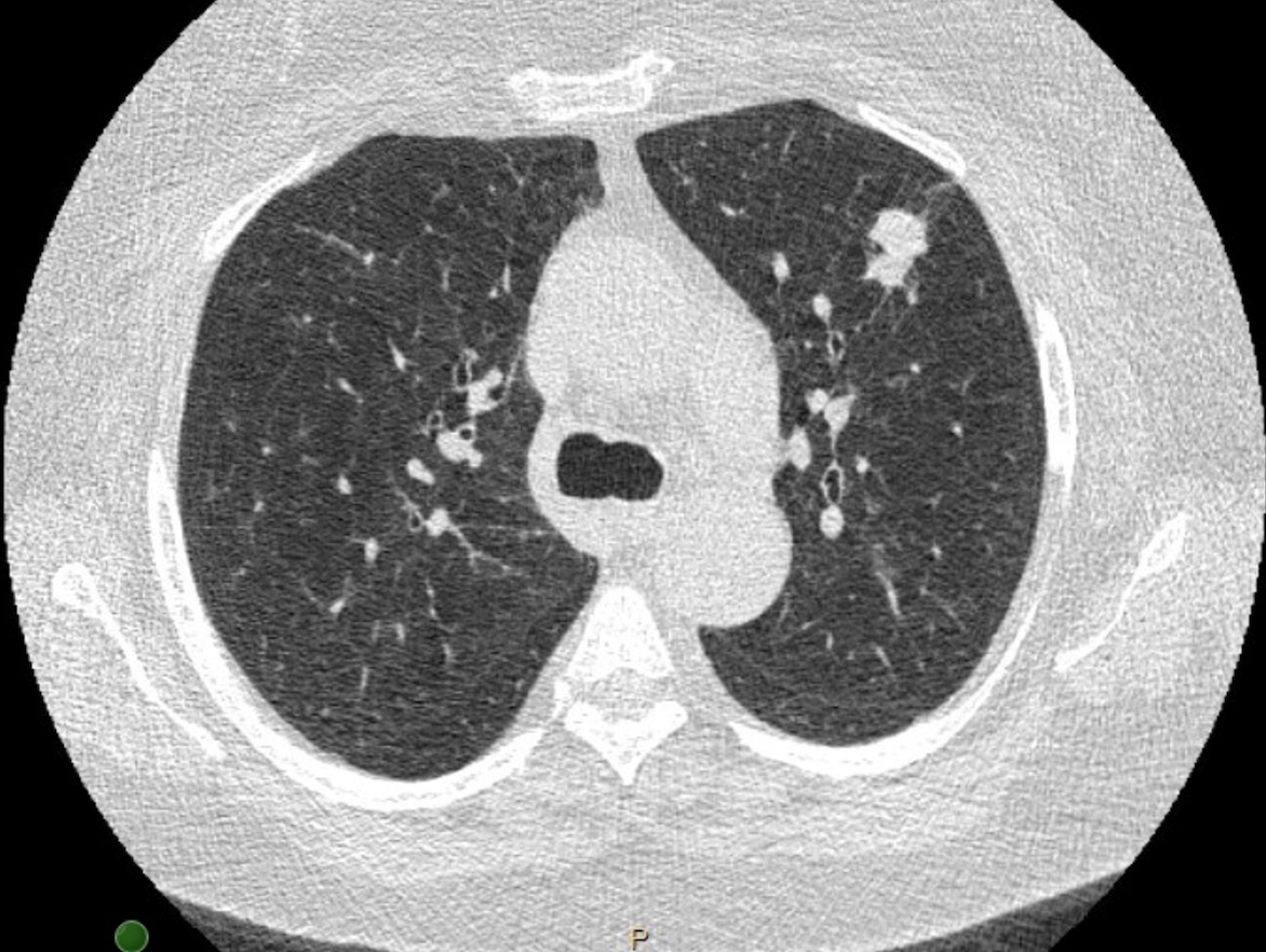 GS_Bronch tweet media