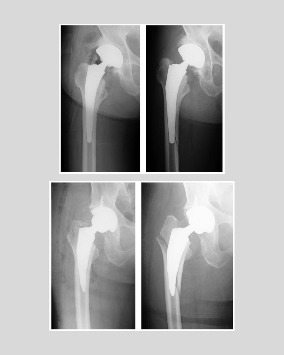 Stem design is a crucial factor influencing the risk of early postoperative periprosthetic femoral fractures and should be carefully considered when selecting implants.

#Fracture #HipReplacement #Ortho <a href="/Hagiwara_Ortho/">萩原 茂生/Shigeo Hagiwara</a>

ow.ly/vj0i50X5u05