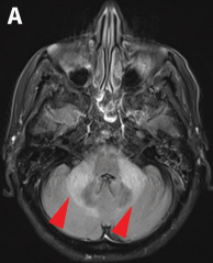 DocNavarrow's tweet image. 🧑‍🦳An 86-year-old woman with long-standing chronic lymphocytic leukemia developed progressive gait imbalance, dysarthria, and binocular diplopia over 4 weeks. No fever or infection signs.

🥛CSF: mild lymphocytic pleocytosis, ↑protein, normal glucose.

🧑‍⚕️What’s the cause?