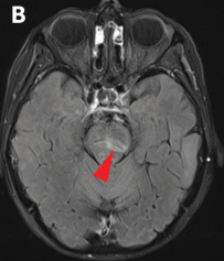 DocNavarrow's tweet image. 🧑‍🦳An 86-year-old woman with long-standing chronic lymphocytic leukemia developed progressive gait imbalance, dysarthria, and binocular diplopia over 4 weeks. No fever or infection signs.

🥛CSF: mild lymphocytic pleocytosis, ↑protein, normal glucose.

🧑‍⚕️What’s the cause?