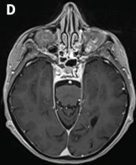 DocNavarrow's tweet image. 🧑‍🦳An 86-year-old woman with long-standing chronic lymphocytic leukemia developed progressive gait imbalance, dysarthria, and binocular diplopia over 4 weeks. No fever or infection signs.

🥛CSF: mild lymphocytic pleocytosis, ↑protein, normal glucose.

🧑‍⚕️What’s the cause?