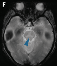 DocNavarrow's tweet image. 🧑‍🦳An 86-year-old woman with long-standing chronic lymphocytic leukemia developed progressive gait imbalance, dysarthria, and binocular diplopia over 4 weeks. No fever or infection signs.

🥛CSF: mild lymphocytic pleocytosis, ↑protein, normal glucose.

🧑‍⚕️What’s the cause?