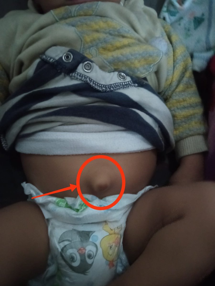 alaa_hamdona's tweet image. My sister’s baby lives in a tent unfit for human life
He suffers from *malnutrition* and now also has a *Omphalitis*
He is in pain, weak, and without proper medical care.

**Please, help us save this innocent child. 
Your kindness could mean survival.**
🔗 gofund.me/3a5e9a571