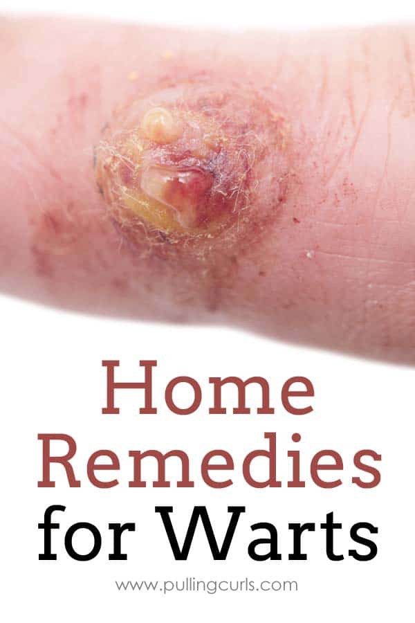 pullingcurls's tweet image. Depending on where the warts are, the type of Herpes it is varies, so we're using oils and treatments that are anti-viral.
Read more 👉 pullingcurls.com/essential-oils…
#DoctorSOffice #EssentialOils #Pullingcurls #AppleCiderVinegar #pullingcurls