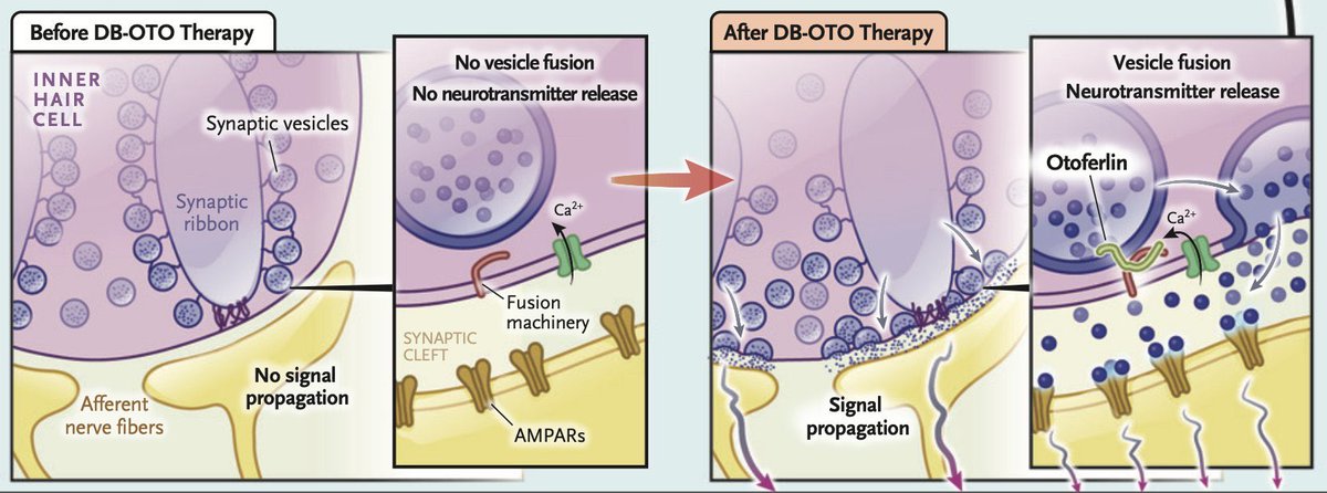 Tıpta gerçekten mucizevi bir çağdayız.

Doğuştan sağırlığı olan 12 çocuğa tek doz gen tedavisi uygulandı. Çocuklardan 3’ü tamamen normal işitmeye kavuştu, 6’sında ise işitme belirgin şekilde düzeldi.