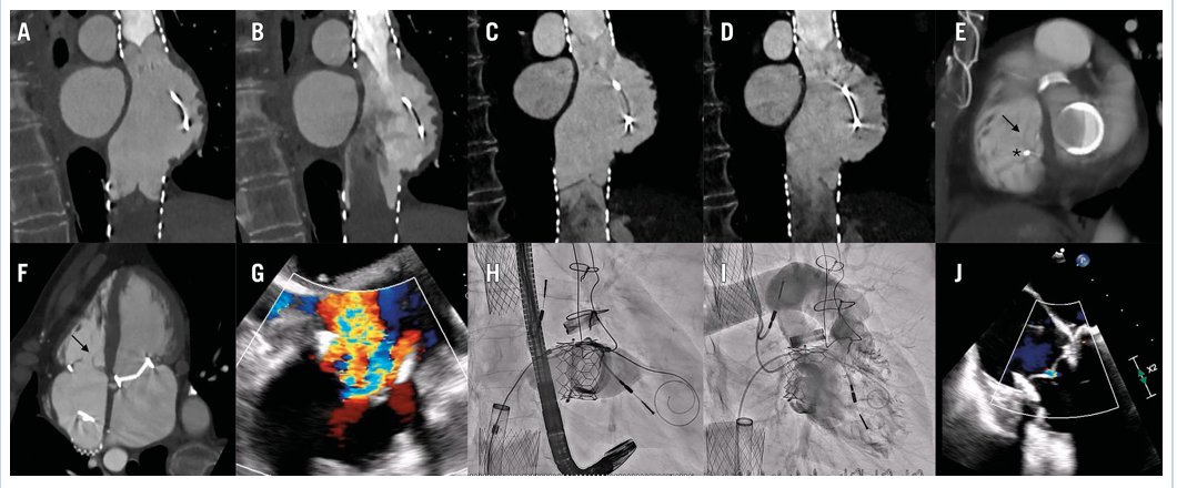 🫀 A rare case of transcatheter tricuspid valve-in-ring following bicaval valve degeneration after prior #CAVI.
Successful implantation of a 32 mm Myval valve restored function, highlighting feasibility of percutaneous intervention through degenerated prostheses. <a href="/AsmaratsL/">Lluis Asmarats</a> ,