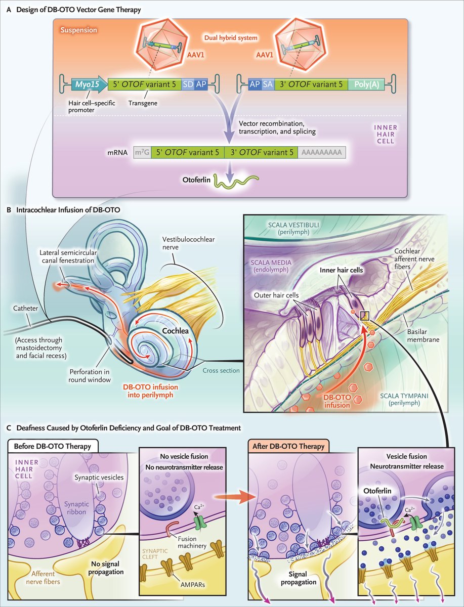 gorka_orive's tweet image. Una sola dosis de terapia génica de adenovirus que implementa DNA que otoferlina (proteína fundamental para la audición) permite una audición acústica normal en 3 de 12 menores tratados. nejm.org/doi/full/10.10…