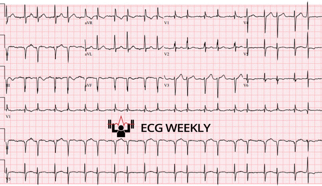 A patient presents to the emergency department with new-onset palpitations. He is hemodynamically stable but noted to have an irregular rhythm on arrival. The following ECG is obtained.....ecgweekly.com/weekly-workout…