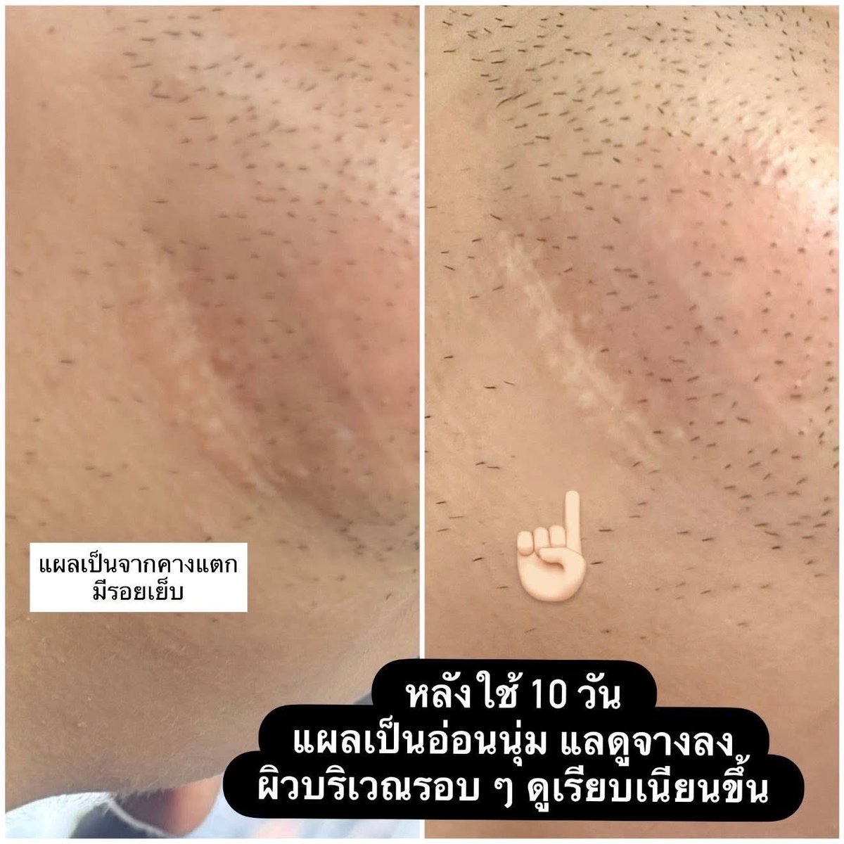 Puricas Plus Advanced Dragon’s Blood C&amp;E Scar Gel 🌳
เจลลดรอยที่อามใช้มานานแล้ว เป็นชิ้นแรก ๆ ที่นึกดถึงเวลามีแผลใหม่ ๆ หรือแผลเป็นเก่าจากการเล่นซนวัยเด็ก แตก เย็บ ใดๆ คือบอกเลยว่าต้องมีติดบ้านจริง ๆ เพราะช่วยเซฟผิวไม่ให้ทิ้งรอยไว้นาน

อามว่าจุดแข็งของตัวนี้เค้า คือ