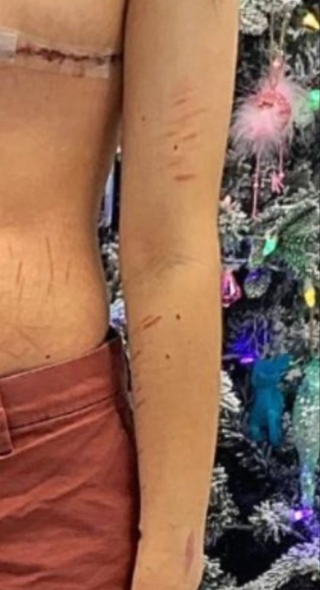 deves_katherine's tweet image. No one has ever adequately explained how doing this to an adolescent girl covered in self harm scars is “life-saving care”