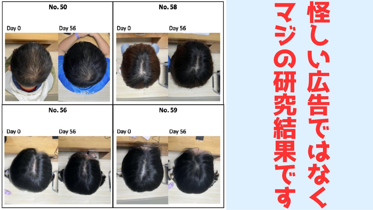 【京大】8週間で髪が「太く・多く・長く」する植物エキスを開発
nazology.kusuguru.co.jp/archives/186427

怪しい広告ではありません
京大らはツボクサという植物が作る超微小な小胞（EV）と成長因子を組み合わせたエキスを使うと、わずか8週間で髪が太く密度も高くなりさらに長さの伸びるスピードも速くなると発表。