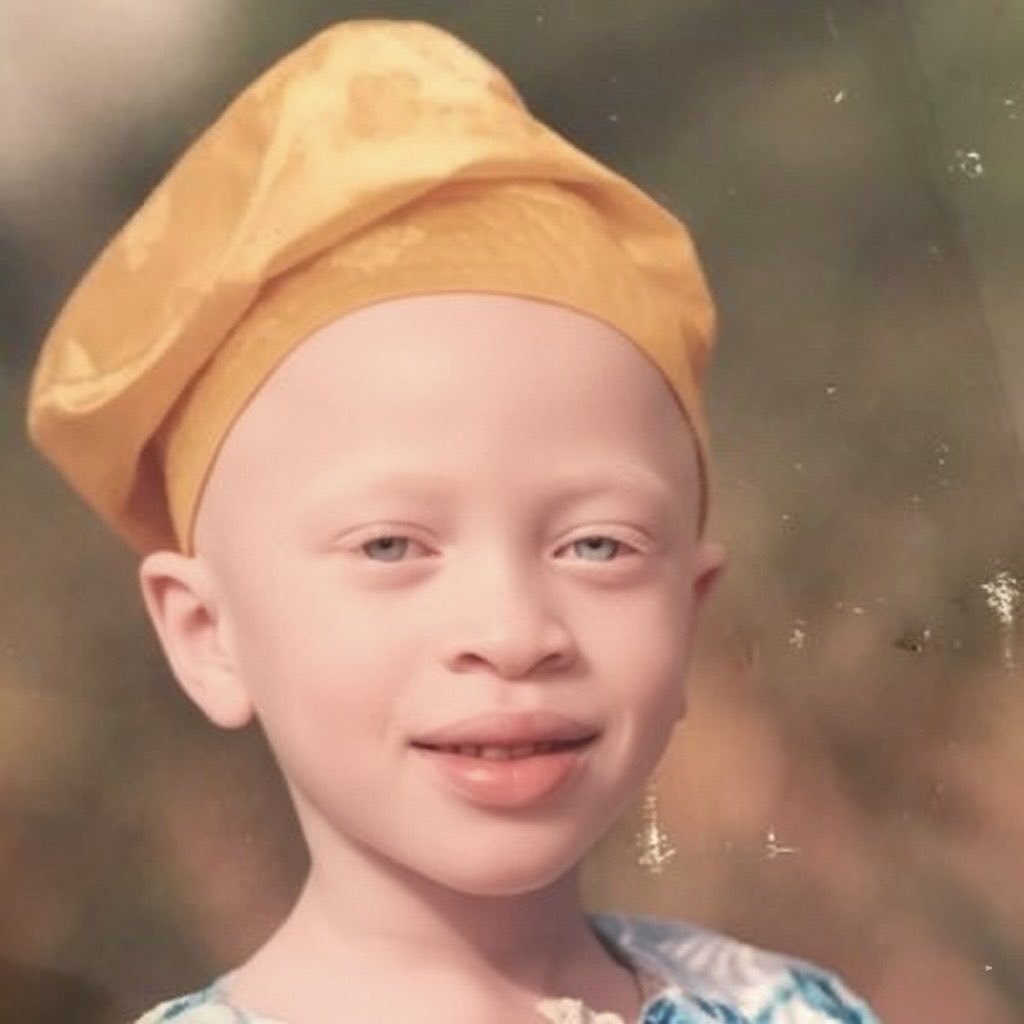 bbygirloyin's tweet image. facts about albino kids?