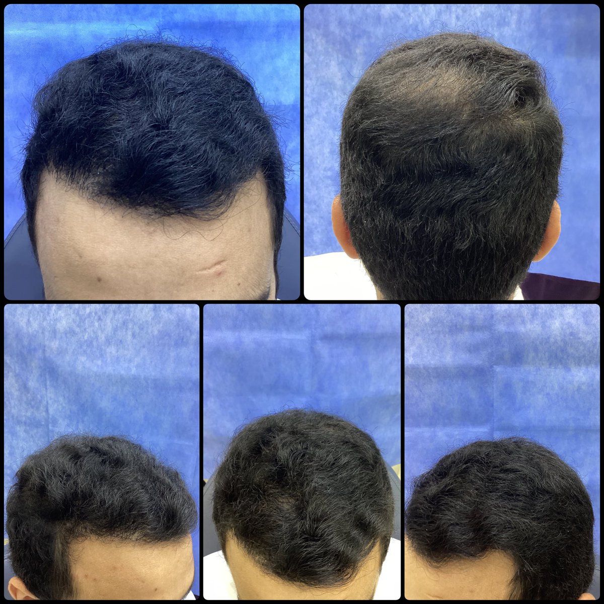 قبل وبعد عملية #زراعة_الشعر بـ٧ أشهر

عدد البصيلات 2500 بصيلة فقط

دائمًا أقول للمراجعين أن العبرة مو عدد البصيلات
مهما وضعت عدد ضخم، فروة الرأس لها حد أقصى بعدد البصيلات اللي ممكن تتقبّلها
أقصى عدد عادة يتراوح بين ٢٥٠٠ إلى ٢٧٠٠ بصيلة 
كل بصيلة قد تحتوي على شعرة او شعرتين او ثلاث