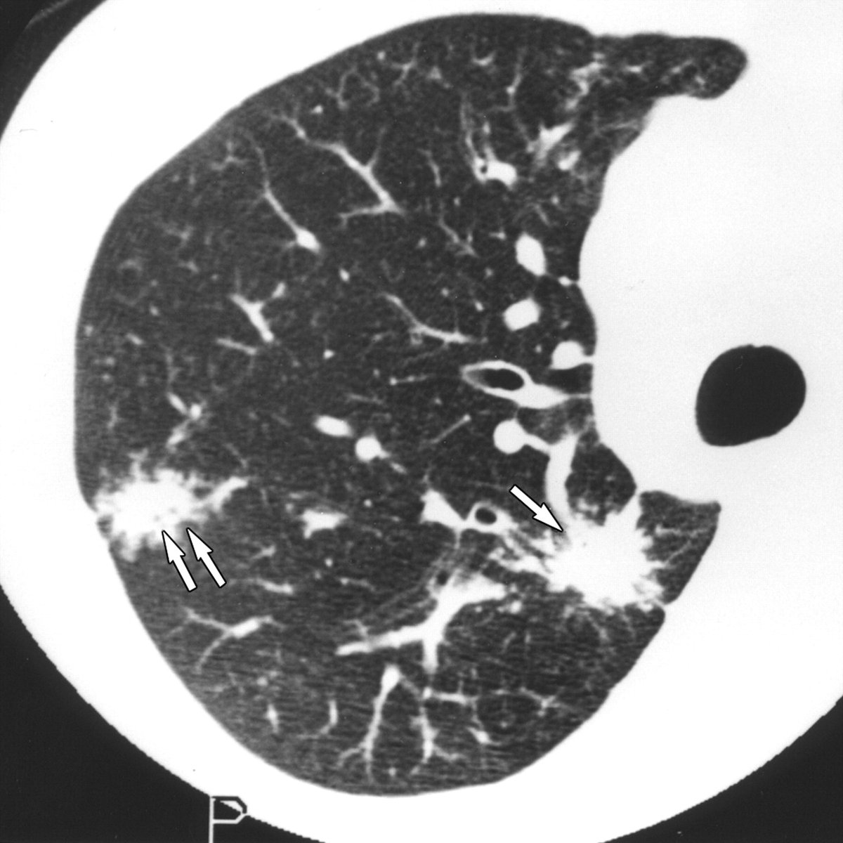 TrackYourHeart's tweet photo. The Galaxy sign is most classically associated with which disease?

A. Sarcoidosis
B. Silicosis
C. Miliary tuberculosis
D. Bronchogenic carcinoma https://t.co/5rqEJCVFoW