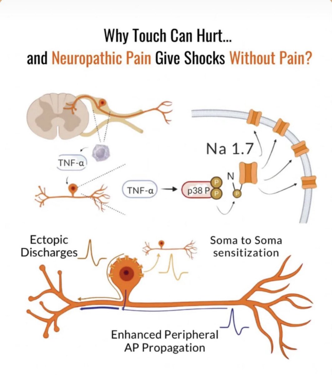 Pain isn’t always about injury — sometimes it’s the nerves themselves that misfire. 🔥
In neuropathic pain, even a gentle touch can trigger chaos in the nervous system.
#Neuroscience #PainEducation #NamtanFilm #LaVozArgentina #Gaza #EXPO2025 #Israel #timeleszの時間ですよ #MECFS