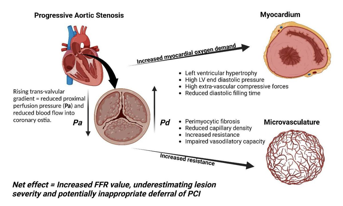 JMMComendador's tweet image. 🔍 Enfermedad coronaria concomitante en TAVI: una puesta al día sobre el rol —y las limitaciones— del estudio funcional en la estenosis aórtica severa.
📘 Heart ↓
🔗 heart.bmj.com/content/111/6/…
📝 SECCE ↓
🔗 secce.es/valoracion-fun…
#TAVI #Coronaria #FunctionalTesting #Heart #SECCE