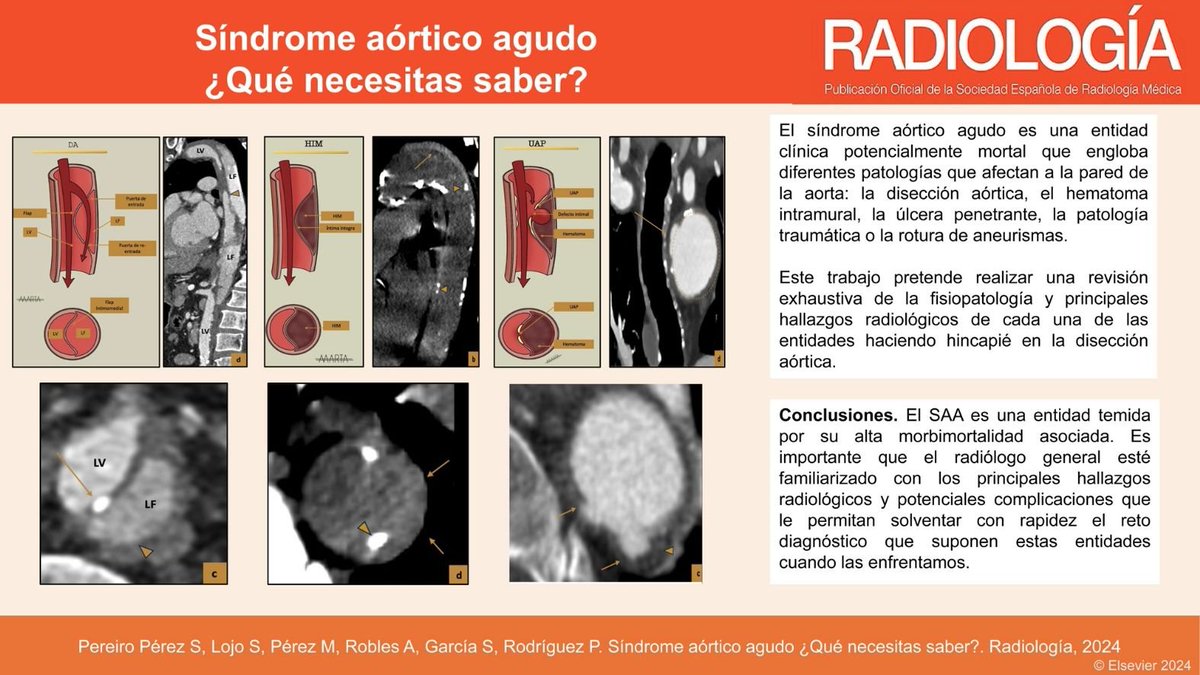 RevistaRADIOLO2's tweet photo. Un fantástico artículo de revisión sobre el Síndrome Aórtico agudo desde el punto de vista radiológico.
Descúbrelo en el siguiente enlace. @SERAUWeb @SERVEISoc 
https://t.co/bc4Qlhb9te
English version: https://t.co/DiySi0Phgl https://t.co/32ak7XhUfQ