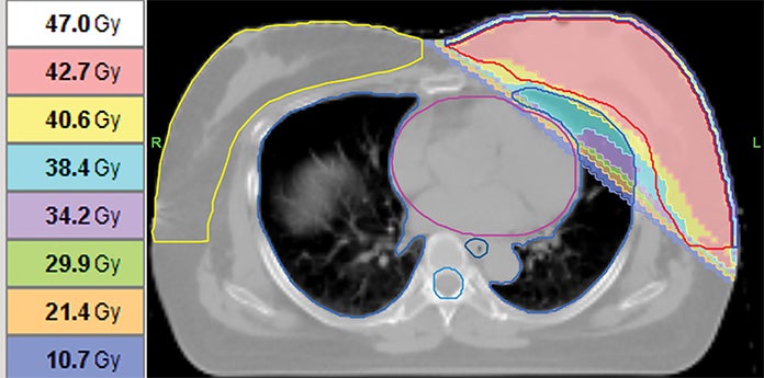 Applied_RadOnc's tweet image. Case Report: Radiation Recall Dermatitis with Docetaxel and Cyclophosphamide in a Case of Early Stage Breast Cancer Considered High Risk
🔗 ow.ly/TALj50XawBh
⚠️ The following content contains medical images that may be disturbing to some viewers. Viewer discretion is…