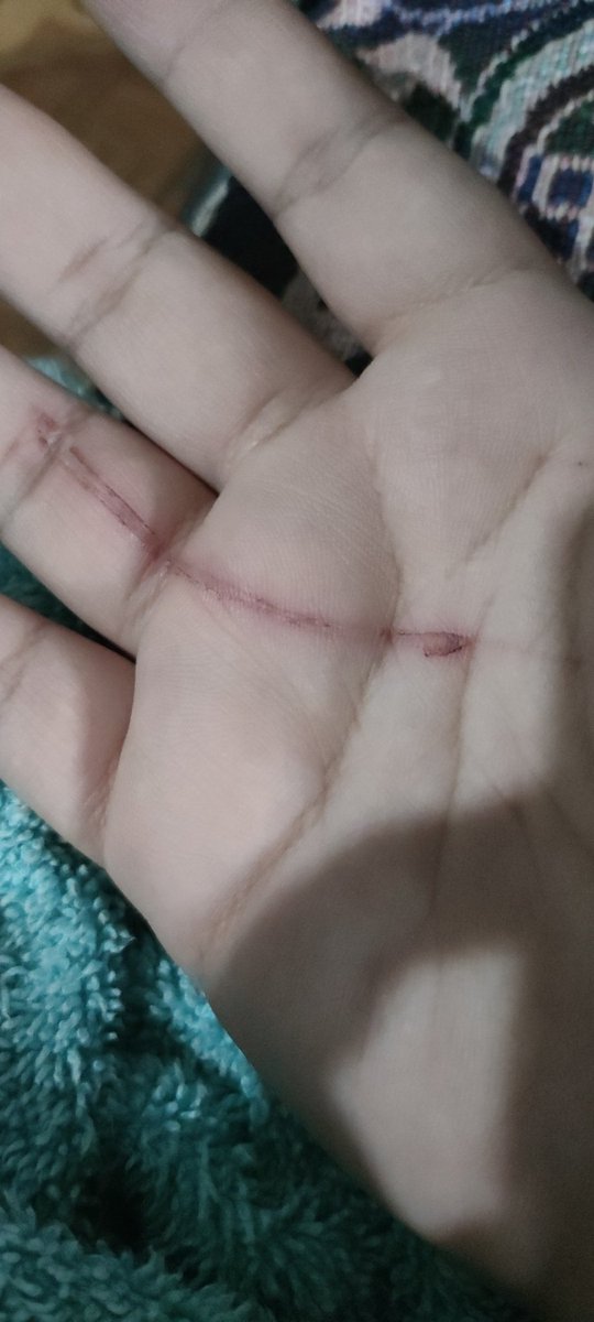 aj17m7's tweet image. Solo intenté darle su medicina a una de mis gatas 🤣🤣🤣 no le di nada porque me atacó antes de poder hacerlo. Lo peor es la zona porque arde bastante 🤣 y ella bien tranquila anda huyendo de mi y ya no he intentado dársela.