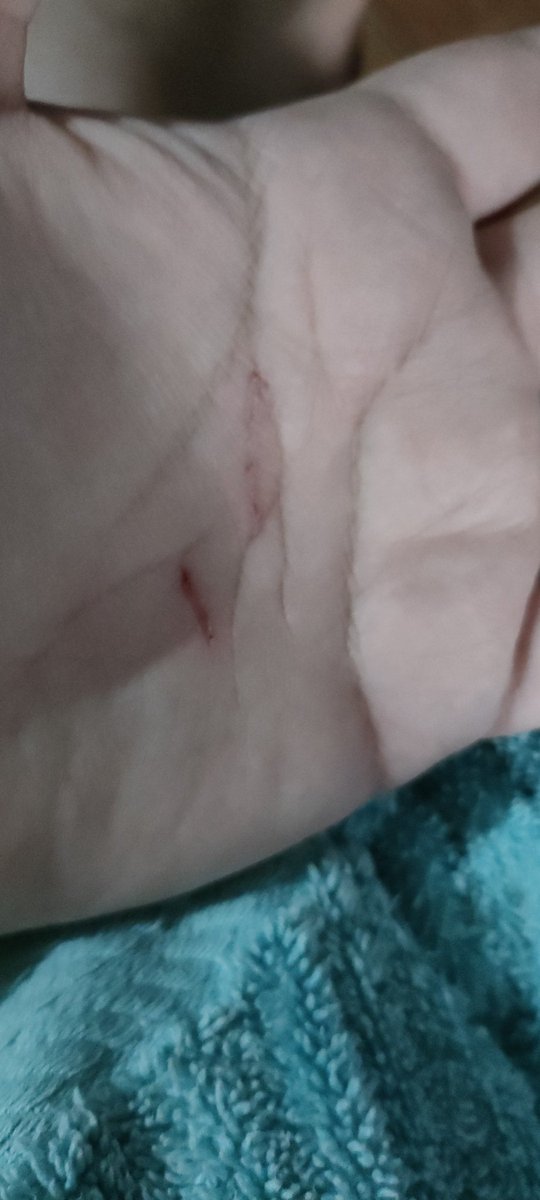 aj17m7's tweet image. Solo intenté darle su medicina a una de mis gatas 🤣🤣🤣 no le di nada porque me atacó antes de poder hacerlo. Lo peor es la zona porque arde bastante 🤣 y ella bien tranquila anda huyendo de mi y ya no he intentado dársela.